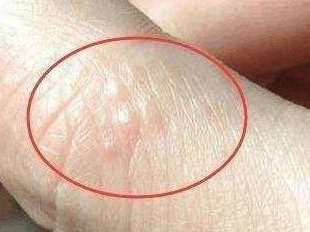 脚上起小水泡还很痒是怎么回事？一文读懂原因与应对方法